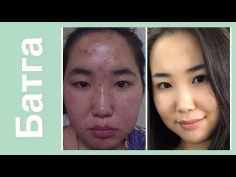 Видео: Батга гарах шалтгаан #2 | What Causes Acne?