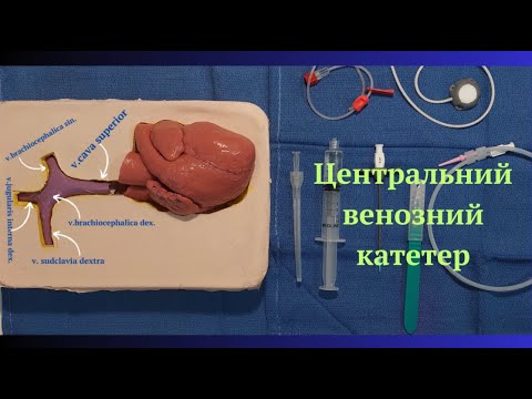 Видео: Центральний венозний катетер. Методика Сельдінгера.