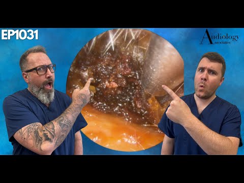 Видео: Липкие, мокрые и большие глубокие ушные серные пробки - EP1031
