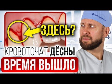 Видео: Кровоточат дёсны — ЭТО ОПАСНО! Зубы можно потерять! Срочно смотри ЭТО (Пародонтит)