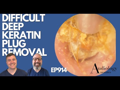 Видео: СЛОЖНОЕ ГЛУБОКОЕ УДАЛЕНИЕ КЕРАТИНОВЫХ ПЛОХОСТЕЙ - EP914