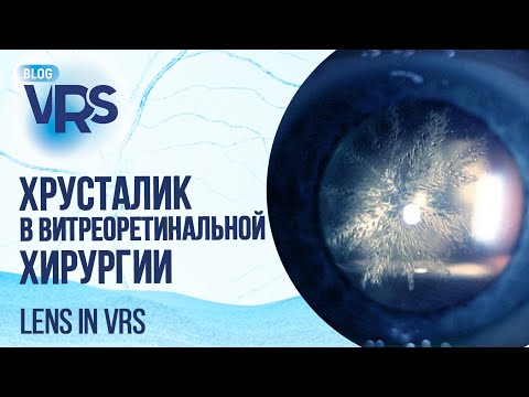 Видео: Хрусталик в витреоретинальной хирургии | Lens in vitreoretinal surgery
