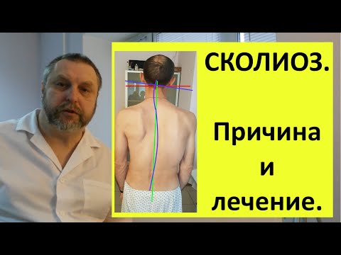 Видео: Лечение сколиоза. Самый лучший способ. И самый быстрый.