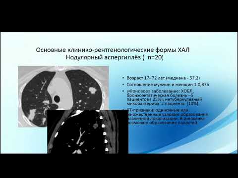 Видео: Николаева Н.Г. «КТ в диагностике хронического аспергиллеза легких»