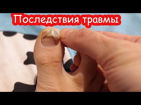 Видео: VLOG Оторвалось пол ногтя