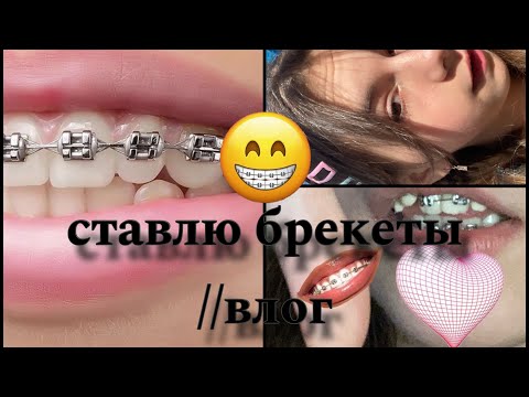 Видео: //СТАВЛЮ БРЕКЕТЫ😱адская боль🤯🤯 #брекеты #ставлю брекеты #установкабрекетов