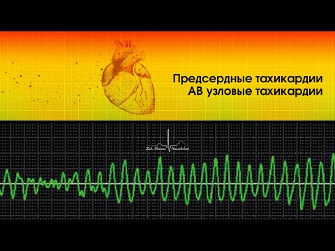 Видео: Предсердные тахикардии. АВ узловые тахикардии.