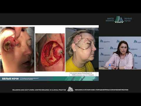 Видео: Особенности плоскоклеточной карциномы кожи головы и шеи (Раджабова З.А.)