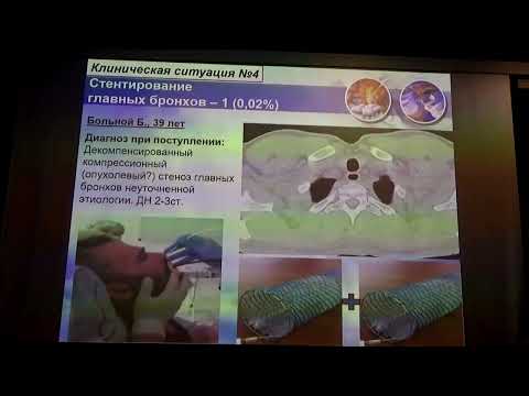 Видео: Бронхо 30 01 Самородов НА Нестандартные случаи в бронхоскопии