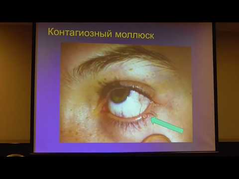 Видео: Современные алгоритмы лечения блефаритов