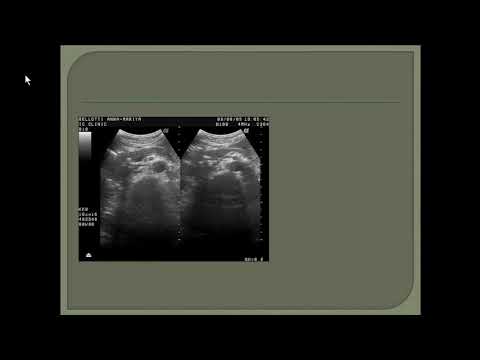 Видео: Фадеев В.Д. «Ультразвуковая диагностика острого панкреатита»