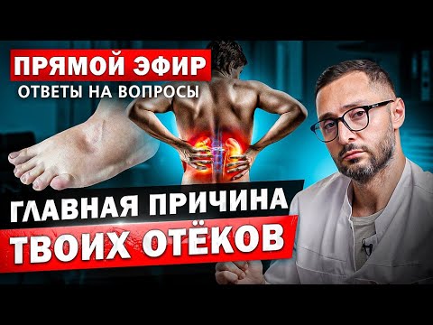 Видео: Главные  причины ОТЕКОВ. Что делать?