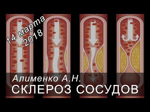 Видео: Склероз сосудов. Алименко А.Н. (14.03.2018)