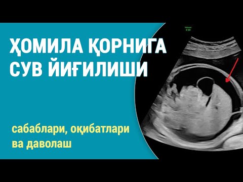 Видео: Ҳомила қорнига сув йиғилиши | Ҳомила истисқоси