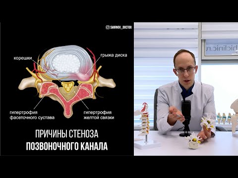Видео: Стеноз позвоночного канала: причины, диагностика и поэтапный план лечения