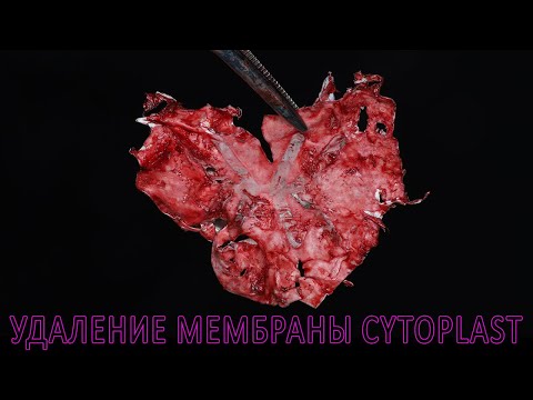 Видео: Раскрытие после костной пластики нижней челюсти, удаление мембраны Cytoplast, имплантация Straumann