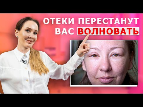 Видео: Причины отёков на лице и как от них избавиться | Как убрать отёки на лице и что нельзя делать!