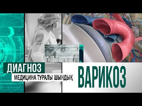 Видео: Варикоздың пайда болу себептері және емдеу жолдары | Диагноз