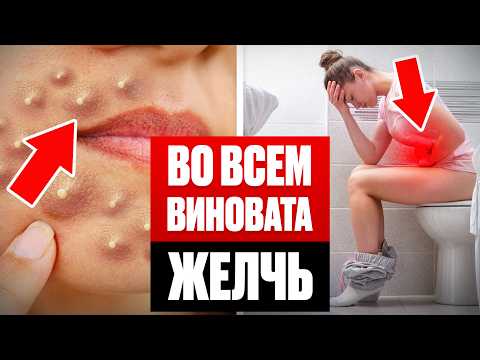 Видео: 10 СИМПТОМОВ, что ЖЕЛЧНЫЙ ПУЗЫРЬ В ОПАСНОСТИ, а желчь отравляет тебя