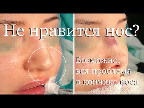 Видео: Ринопластика кончика носа