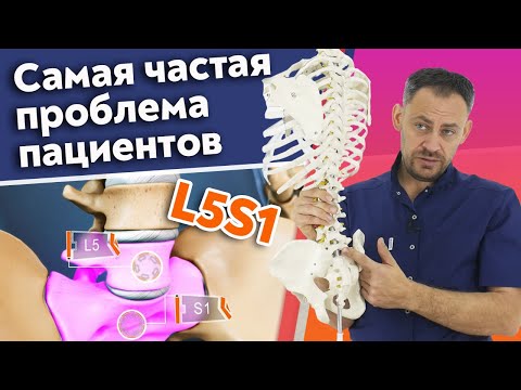 Видео: Грыжа L5 S1 / Как лечить межпозвонковую грыжу поясничного отдела?