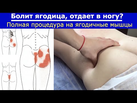 Видео: Болит ягодица отдает в ногу. Процедура на ягодичные мышцы