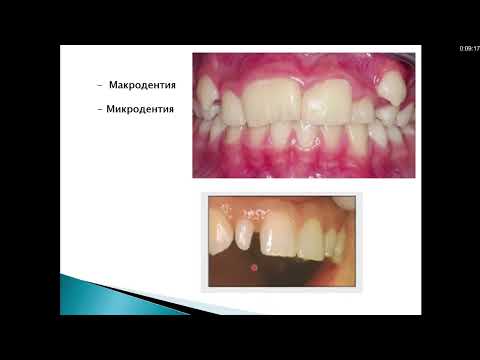 Видео: Кариесология 2.1 Некариозные поражения, возникающие до прорезывания