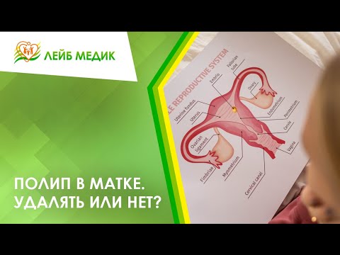 Видео: 😟 Полип в матке. Удалять или нет?