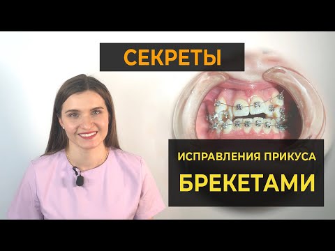 Видео: Секреты исправления прикуса брекетами – начало