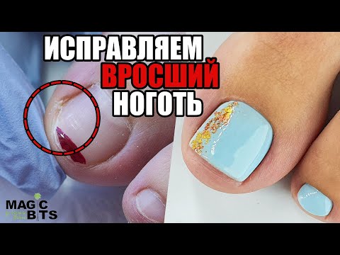 Видео: ИСПРАВЛЕНИЕ ВРОСШИХ НОГТЕЙ + АППАРАТНЫЙ ПЕДИКЮР