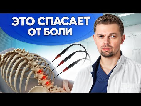 Видео: Как победить боль в спине? Радиочастотная денервация фасеточных суставов.