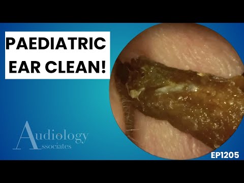 Видео: Экстремальное удаление ушной серы | Огромная длинная пробка и детский футляр - EP1205