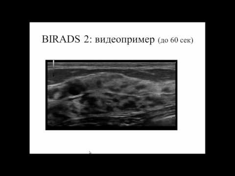 Видео: BIRADS: категоризация очаговых изменений молочных желез