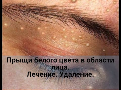 Видео: Прыщи белого цвета в области лица. Лечение.Удаление.