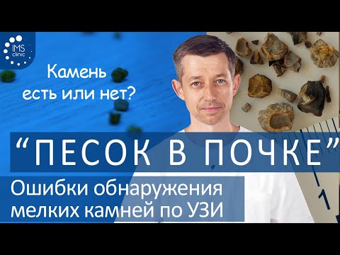 Видео: Мелкий камень почки (песок в почке). Почему нельзя доверять УЗИ