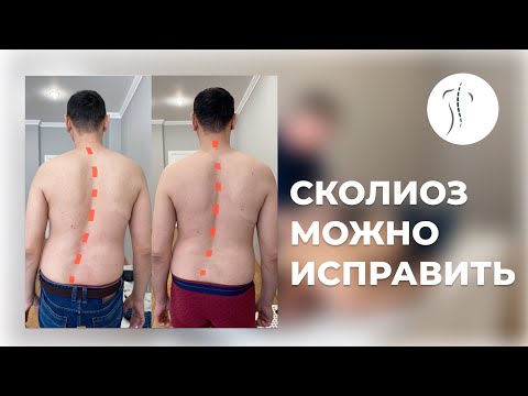 Видео: Сколиоз можно исправить | Костоправ Саксин Алексей