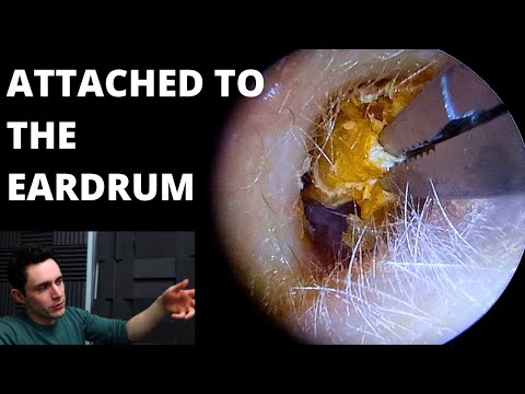 Видео: Новые беруши Hook & Crocs против омертвевшей кожи