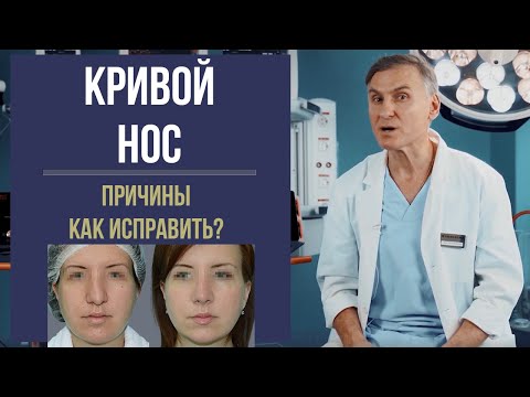 Видео: КРИВОЙ НОС 🤥 КРИВАЯ ПЕРЕГОРОДКА НОСА: КАК ВЫРОВНЯТЬ?