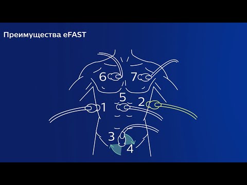 Видео: Демонстрация ультразвукового протокола eFAST. Philips Lumify