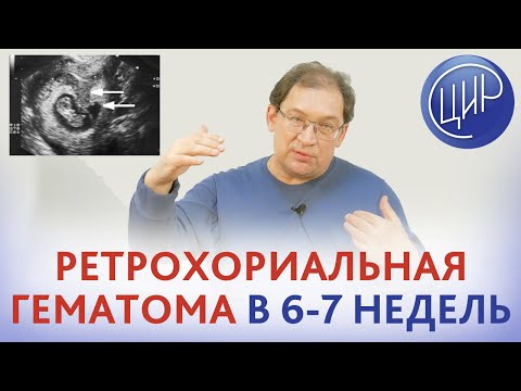 Видео: Ретрохориальная гематома в 6-7 недель, гипертонус матки и низкая плацента - опасно ли это? Гузов И.И