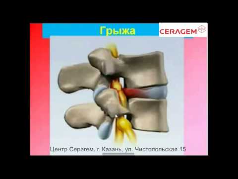 Видео: Хорошая лекция об остеохондрозе врача Клиники Управделами Президента РФ Тетюка В.