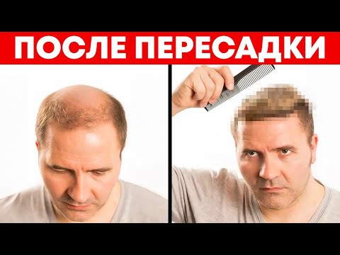 Видео: Что вас ждёт после пересадки волос | Александр Долгов