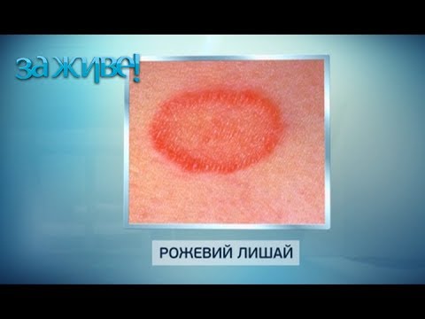 Видео: Как избавиться от лишая: ТОП-3 способа как лечить лишай | За живе!