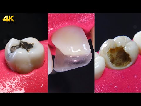 Видео: 4 ЛУЧШИХ ВИДЕО О ЛЕЧЕНИИ СТОМАТОЛОГИЙ В 4K — Видеоподборка