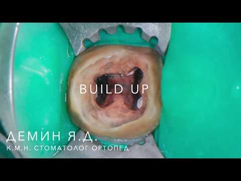 Видео: Восстановление зубов прямой композитной надстройкой (build-up)