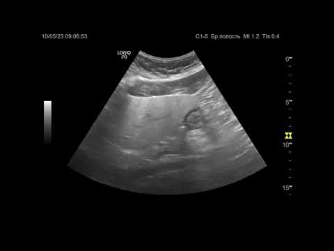 Видео: УЗИ. Доктор Иогансен. Видеопримеры. Выпуск 15. Жировая инфильтрация печени.