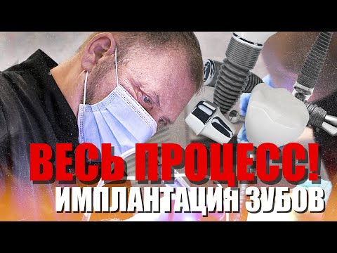 Видео: Имплантация зубов, весь процесс