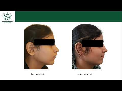 Видео: Цефалометрический анализ 2 (скелетный сагиттальный анализ с использованием анализа Штайнера)