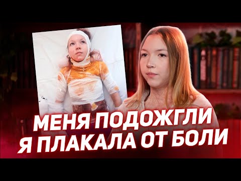 Видео: 🔥 Меня ПОДОЖГЛИ подростки, спасла от ОГНЯ только ЛИЦО / История Киры Красновой
