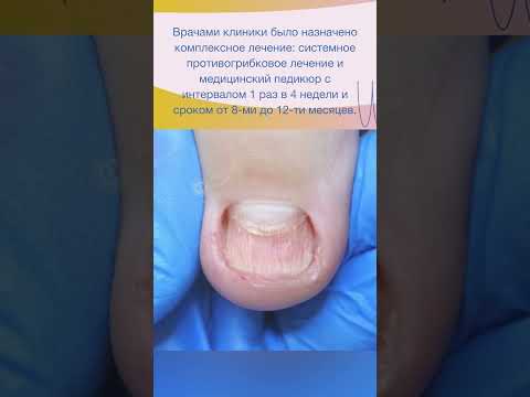 Видео: #медицинскийпедикюр #педикюр #ногти #лечениеногтей #грибок #грибокногтей